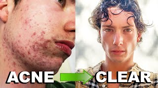Download lagu MY ACCUTANE JOURNEY | Clearing 6 Years of Acne (Big Acne Transformation!) mp3
