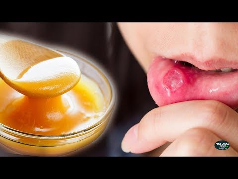 How to Get Rid of a Cold Sore | Cold Sore Remedies |...
