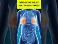5 Early Signs Of Breast Cancer You Should Never Ignore