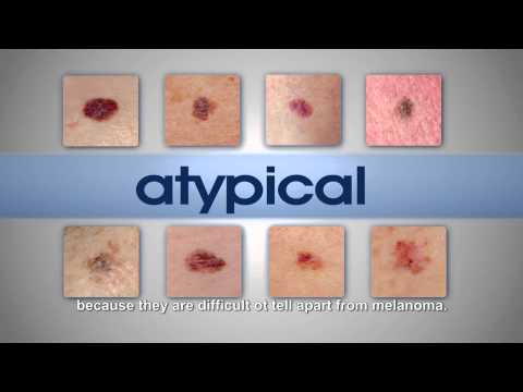 Melanoma and Melafind
