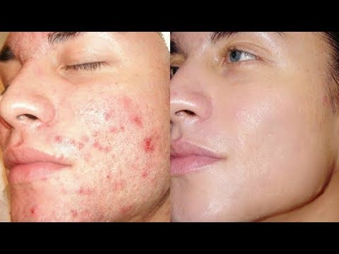 How To Get Rid of Acne & Pimples In Just 21 Days / Get Clear Skin, Remove Acne, Remove Pimples Video