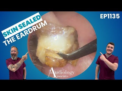Dry, Deep & Infected Ear Wax Plug Removed!   EP1135