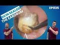 Dry Deep Infected Ear Wax Plug Removed EP1135