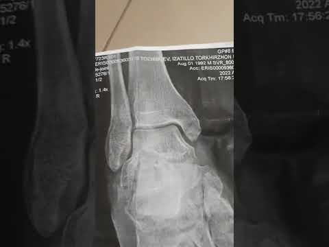 Москва синикчи. Қалтис чиққан оёқ. +79258088425