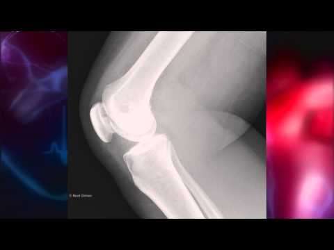 Glucosamine and chondroitin and their effect on joint pain