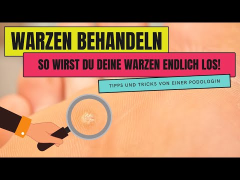 WARZEN BEHANDELN | So wirst du WARZEN endlich los!