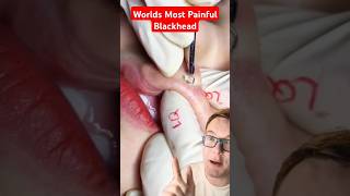 Crazy Painful BLACKHEAD REMOVAL #shorts