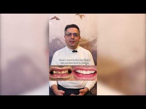 Hollywood Smile Transformation in Turkey | 3-Day Smile Makeover 