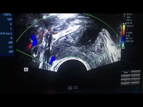 Volume prostate normal