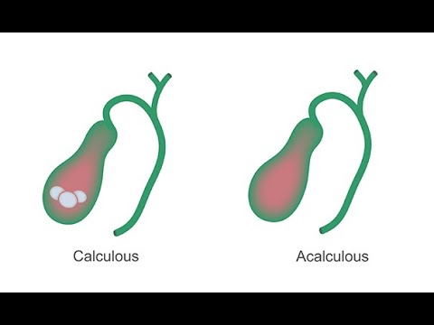 Identifying acute cholecystitis