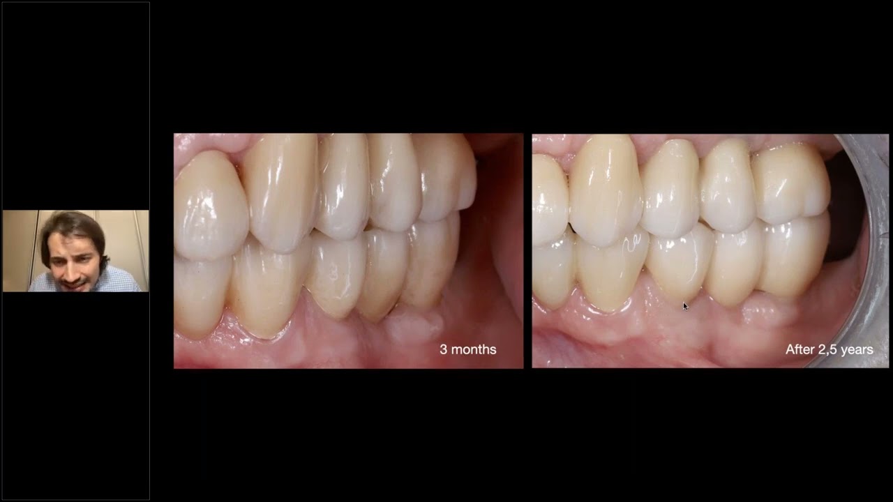 BEGO Implant Systems – Soft Tissue Treatment in the Aesthetic Region