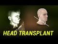 What Happened to the Head Transplant?