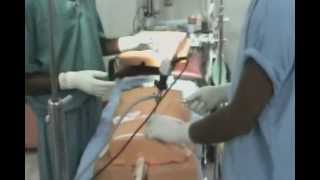 preview picture of video 'Endospine surgery demo by Dr. Thiraviam .wmv'