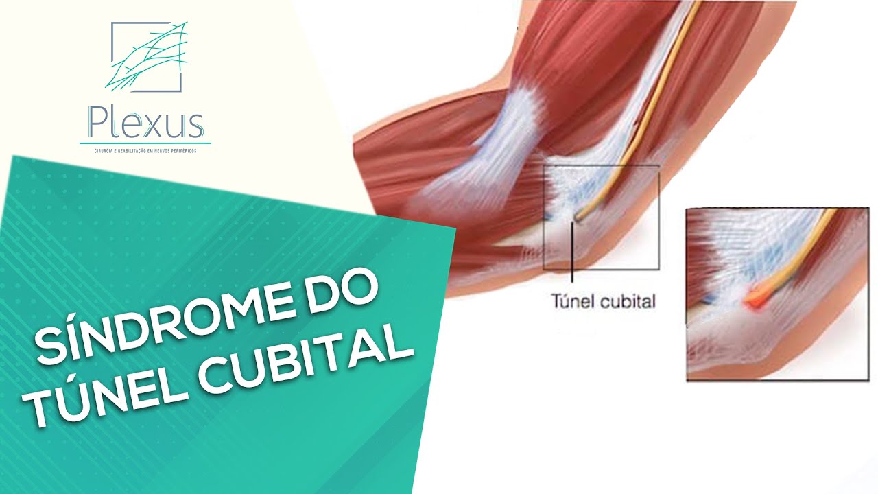 Síndrome do Túnel Cubital - Causas e tratamento