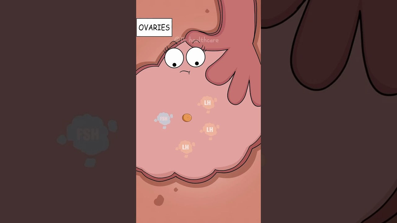 What Actually Causes PCOS in Women?