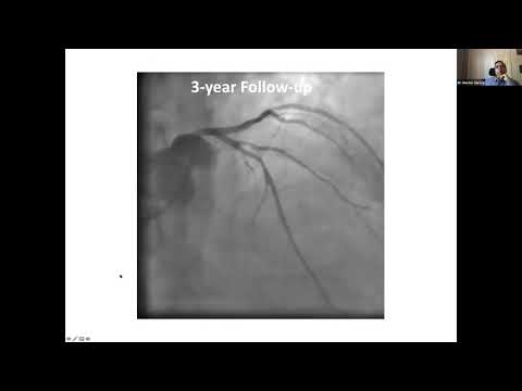Stent bioabsorbible: ¿en dónde estamos?, ¿confiable en lesiones coronarias complejas?