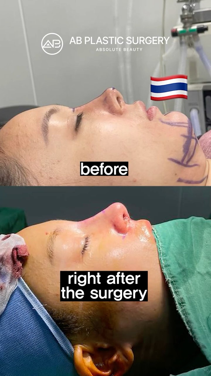 Nose Reborn in 90 Days!