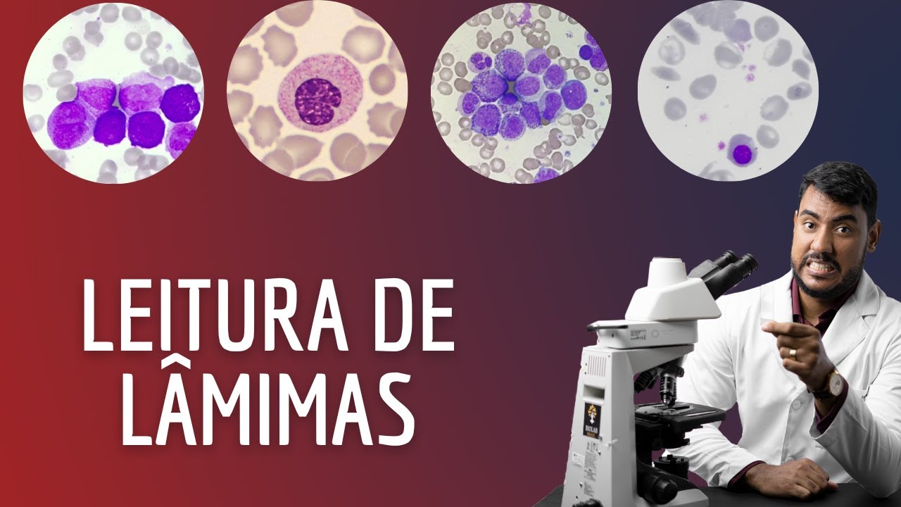 Leitura de lâminas - Pelguer, LPA, Doença Falciforme e LMC