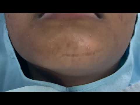 Scar Revision Surgery Treatment