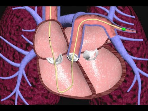 Swan Ganz Pulmonary Artery Catheter Animation by Cal Shipley, M.D.