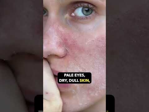 Vitamin B12 Deficiency: Symptoms, Causes, and Solutions! | Dr. Sarin |