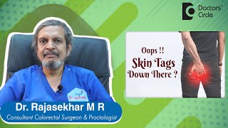ANAL SKIN TAGS -Irritating down there? Cause,Symptom & Treatment-Dr.Rajasekhar M R | Doctors