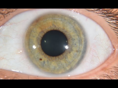 Thumbnail: Iridology helps us to understand our personality