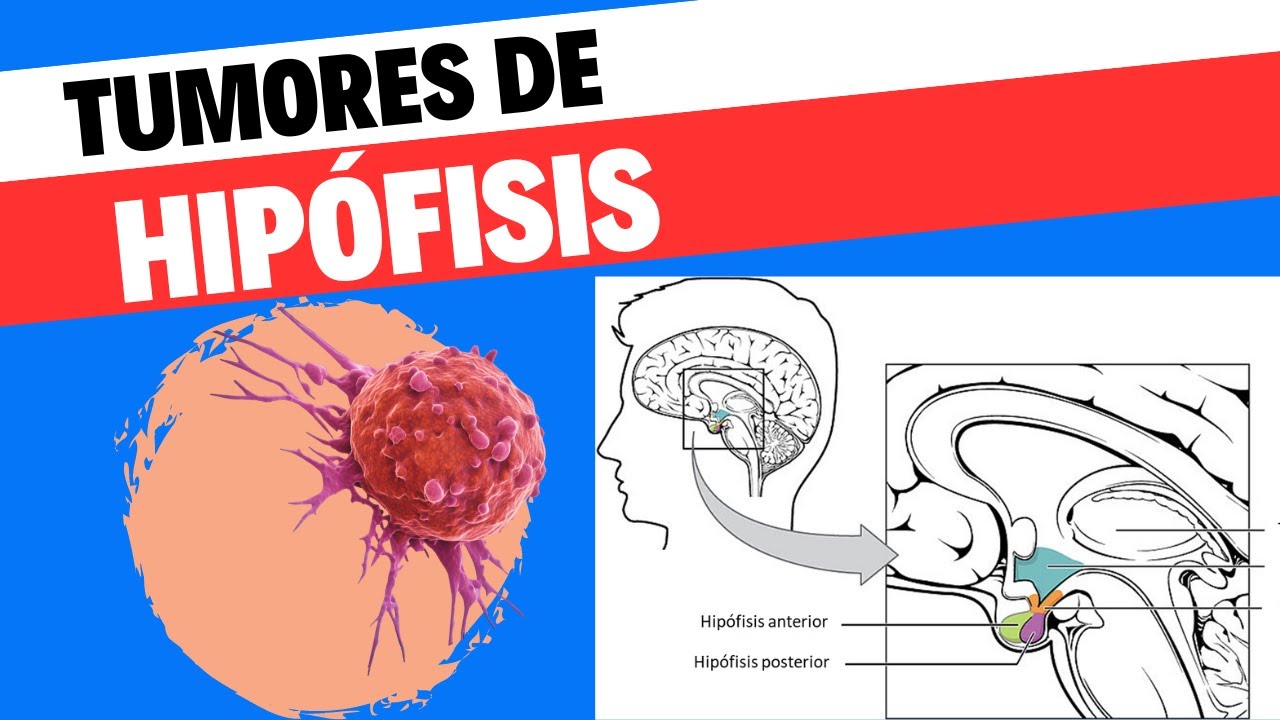 Tumores de hipófisis. Todo lo que necesitas saber