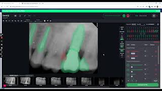 Dentrix Ascend Auto Charting Detect Denti AI