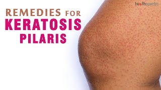 8 Remedies for Keratosis Pilaris