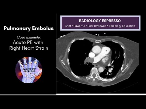 ACUTE PULMONARY EMBOLISM: Case Example - Acute PE with Right Heart Strain