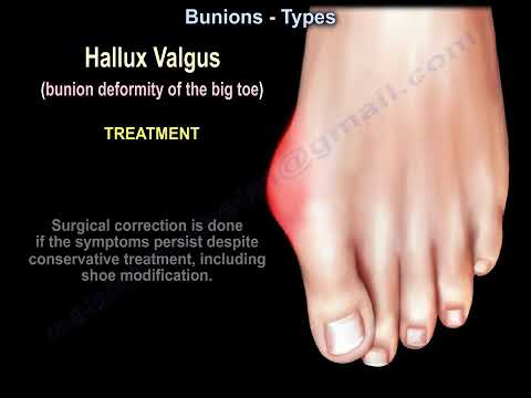 Rodzaje haluksów: haluks koślawy, haluks krawca i haluks grzbietowy - wyjaśnienie