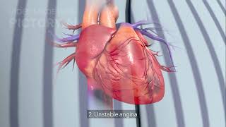 The Bruce protocol #pdms