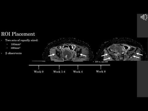 Jose Perucho - Intravoxel Incoherent Motion MRI Assessment of Chemoradiation Induced Changes