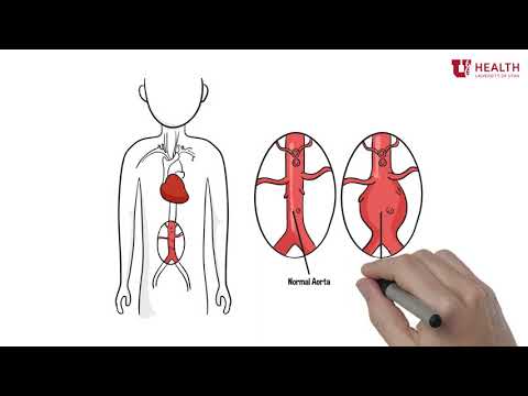 What is an Abdominal Aortic Aneurysm?