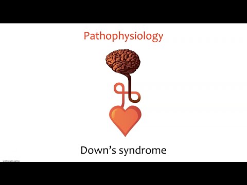 Down syndrome (Trisomy 21)