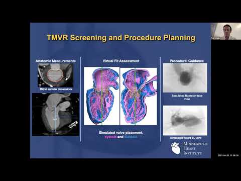 Miami Valves 2021 Virtual Lecture Series Session 3-  5/5/2021