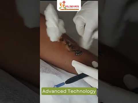 1 hour laser tattoo removal, nagpur, 18 to 50 years