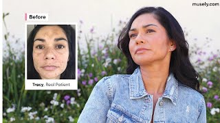 MUSELY's THE SPOT CREAM | I feel beautiful | REAL PATIENT REVIEW OF MUSELY SKINCARE
