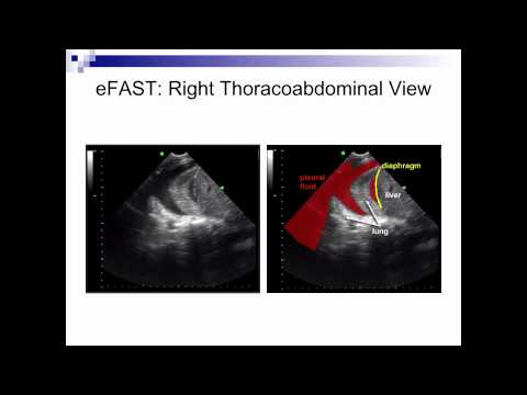 Abdominal Ultrasound in Critical Care