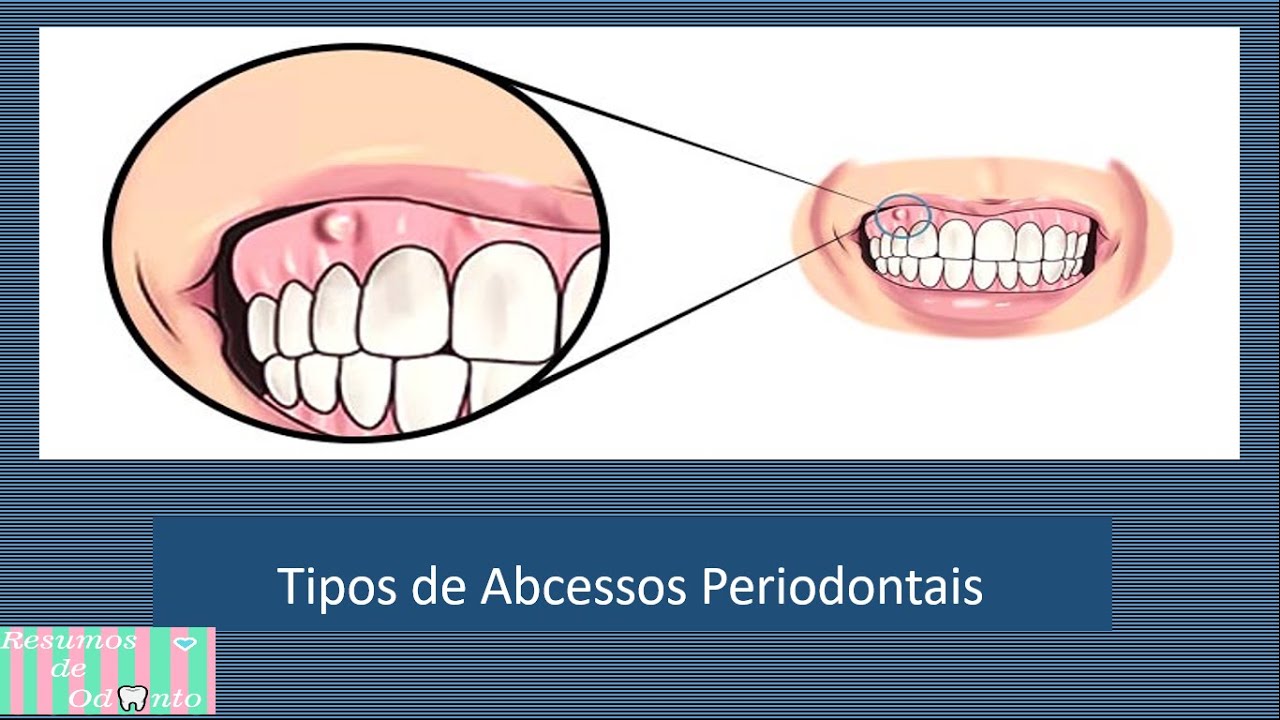Abcessos Periodontais | Doenças em 5 minutos - Resumos de Odonto