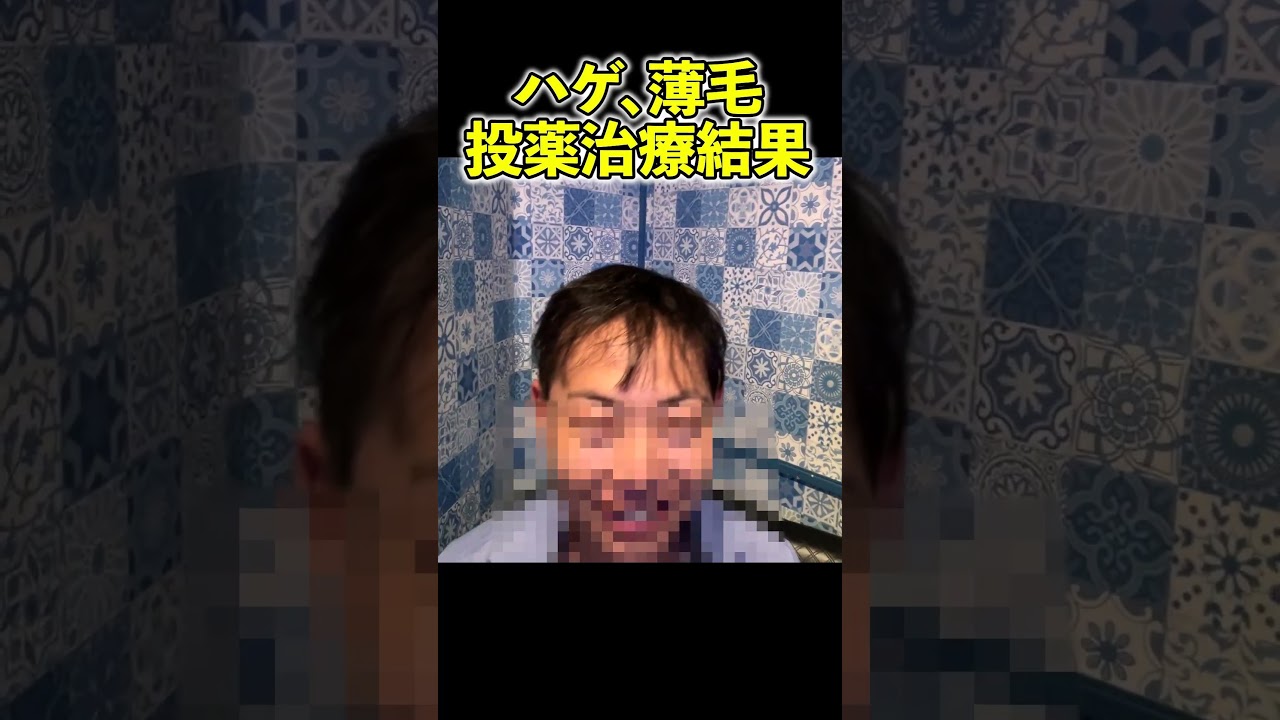 ２年間のAGA投薬治療の結果…　#shorts