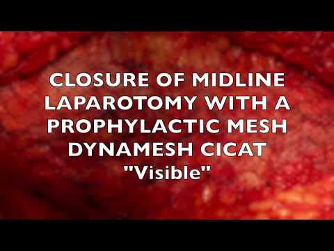 Prophylactic onlay mesh with Dynamesh Cicat (english version)