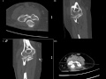 Elbow CT Planes