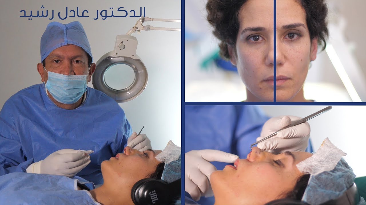 Rhinoplastie sous anesthésie locale — Dr. Aadil Rachid