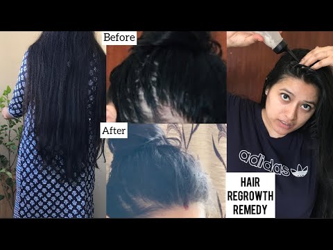 Rosemary water for Hair Growth before and after|My25...