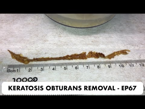 11 CM PIECE OF SKIN BLOCKAGE REMOVED FROM PATIENTS EAR - EP67
