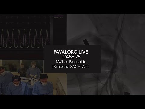 Favaloro Live Case N° 25 - TAVI en Bicúspide (Simposio SAC-CACI)