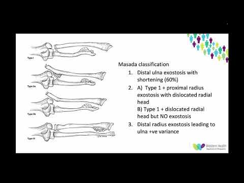 OrthoFracs – Osteochondrom und MHE von Dr. Andrei Diacon