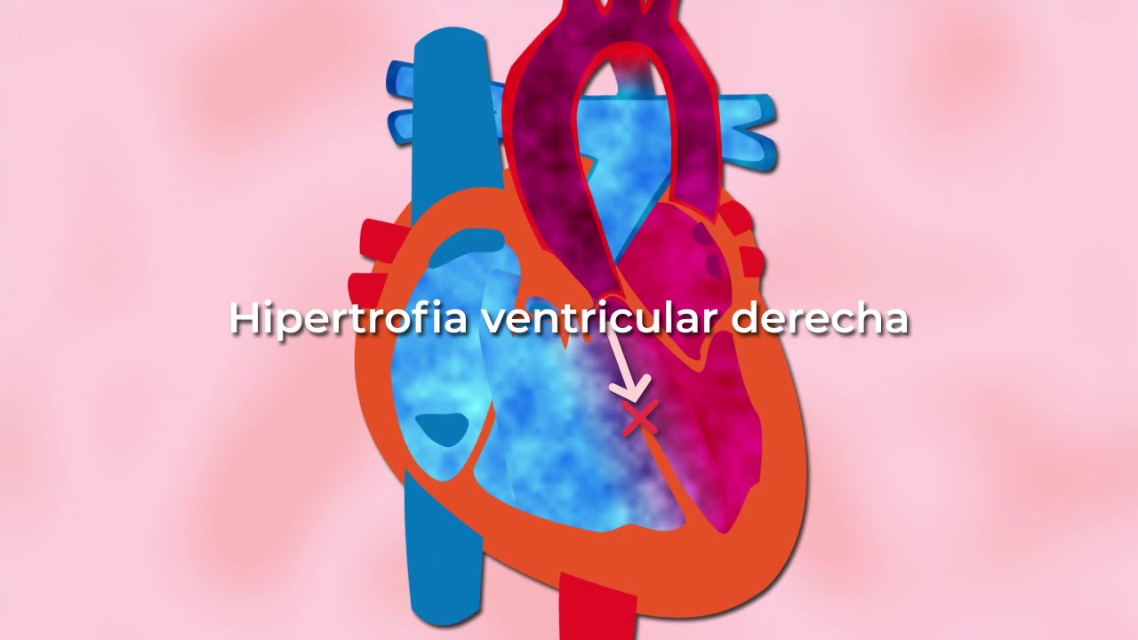 Tetralogía de Fallot